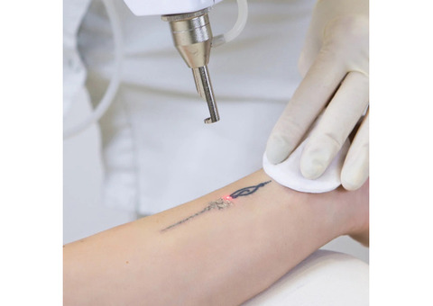 Discover Professional Tattoo Removal Treatment in Tamworth