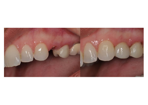 Get Dental Implants - The Ultimate Solution for Missing Teeth