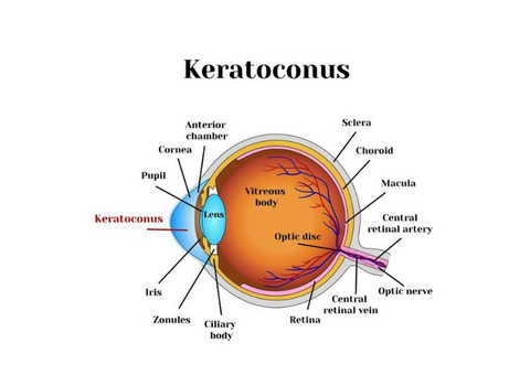 Dubai Keratoconus Treatment Specialist