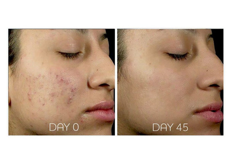 Acne Treatments for All Skin Types – OC Skin Bankstown