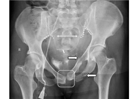 The Impact of Pelvic Unleveling: An X-Ray Perspective