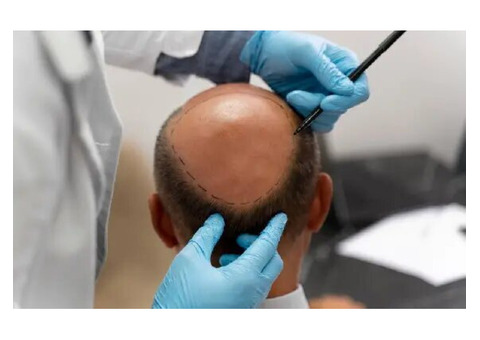 Free Natural looking Hair Transplant in Delhi