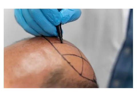 Get Natural Results with FUE Hair Transplant in Greater Kailash