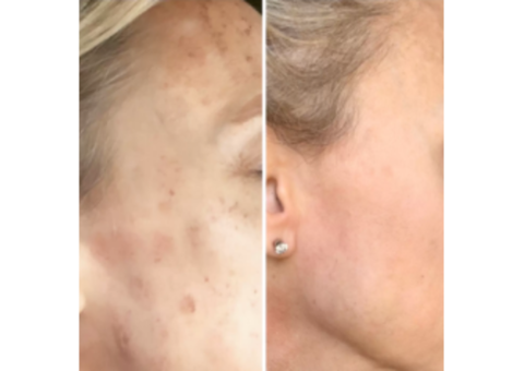 Sun Damage & Redness Treatments at Wymore Laser