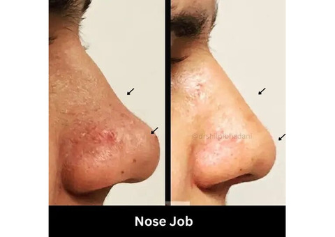 Best Rhinoplasty in Delhi- Ethnic Nose Job