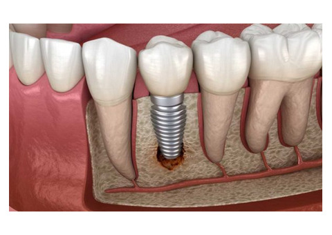 Get the Best Dental Implants In Thane