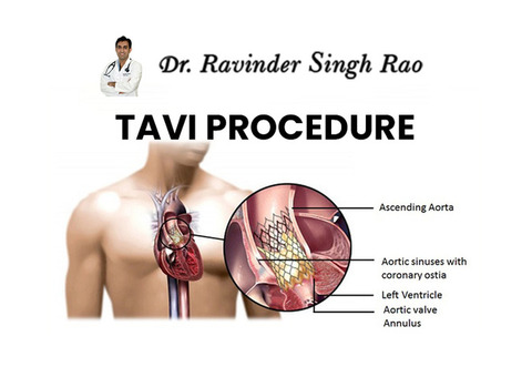 Best Cardiologist for TAVI Procedure in India: Dr. Ravinder Singh Rao