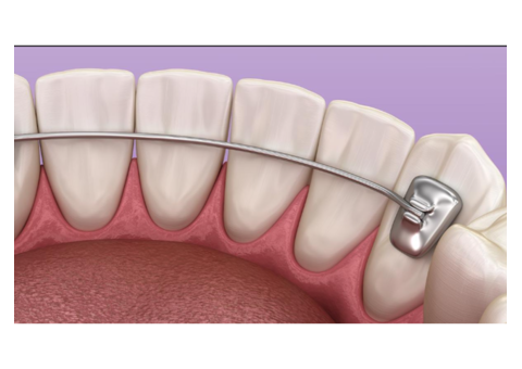 Teeth Straightening Braces in Murrieta: Pesh Orthodontics