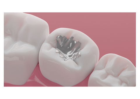 Affordable Tooth-Colored Fillings Now Available