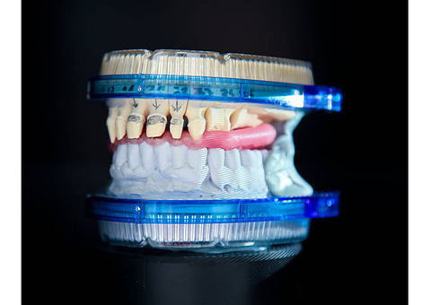 The Role of CAD CAM in Dental Implants