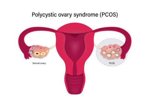 How PCOS Symptoms Can Affect Your Skin and Hair