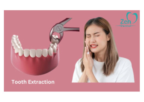 Tooth Extraction Service in Sarjapur Road, Bangalore – Zen Dental Care