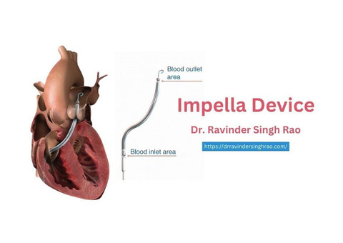 Best Impella Device Procedure Doctor in India: Dr. Ravinder Singh Rao