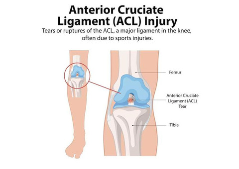 Move Freely Again with ACL Ligament Surgery in Dubai | Sports Med