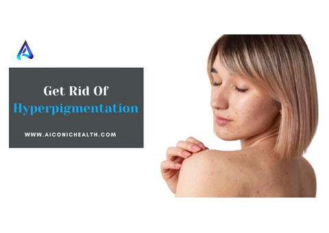 How To Get Rid Of Hyperpigmentation