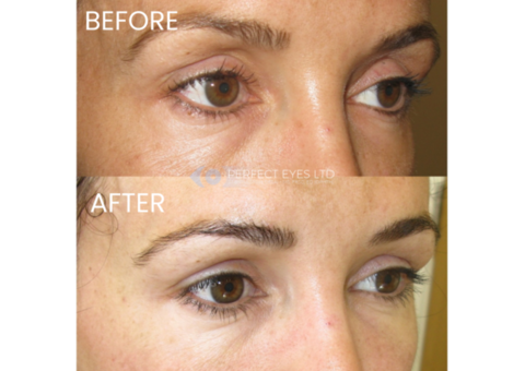 Upper Eyelid Filler in London