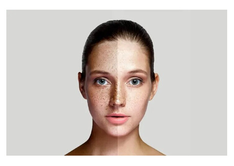 Pigmentation Treatment in Delhi