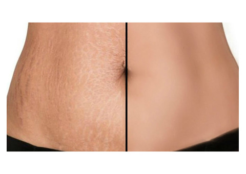 Effective Laser Stretch Mark Removal in Amritsar – Aesthetic World