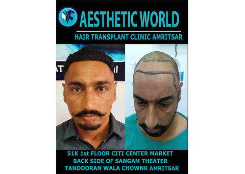 Restore Your Confidence with the Best Hair Transplant Clinic