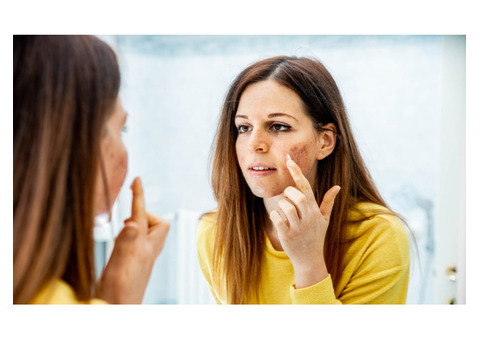 Get clear skin with acne scar treatment in noida