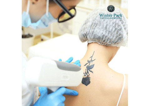 Advanced Laser Tattoo Removal - Effective & Gentle Solutions