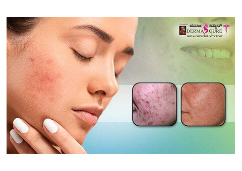 Effective and Deep Acne Scar Treatments in Bangalore - Dermaqure