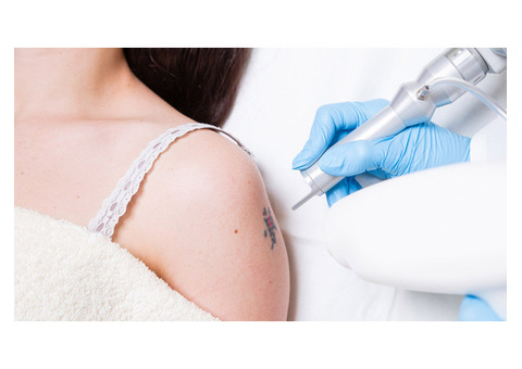 Safe & Effective Laser Tattoo Removal Treatment in Amritsar