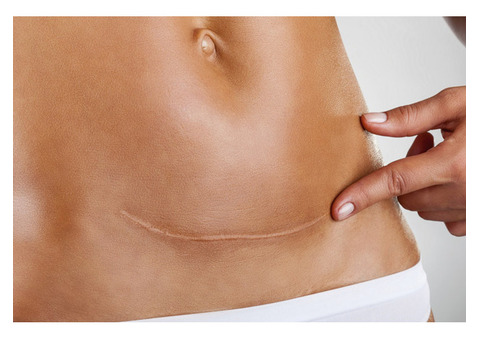 MCA Micro-Needling for Stretch Marks: Restore Smooth Skin