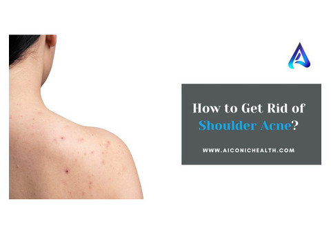 How to Get Rid of Shoulder Acne?