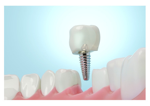 Miami’s Trusted Choice for Dental Implants – Smile Brighter Today!