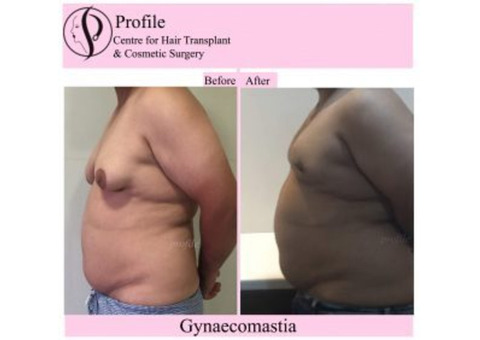 Gynecomastia Surgery in Ludhiana – Safe, Affordable, and Effective