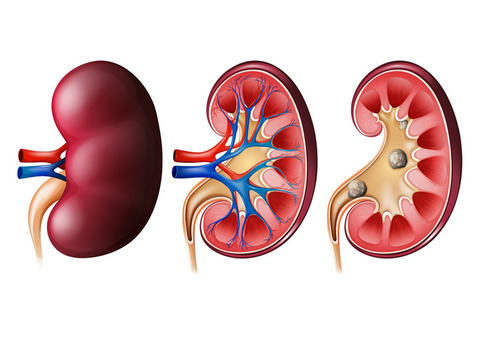 Comprehensive Guide to Kidney Stone Treatment in Dubai