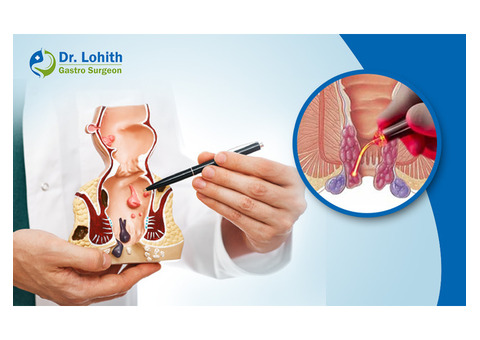 Best Piles Treatment in Bangalore - Dr. Lohith U