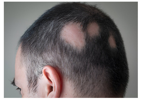 Can Alopecia Areata Be Treated Without Medications?