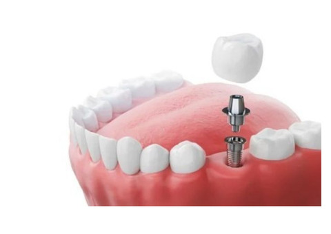 Best Dental Implant in Jadavpur