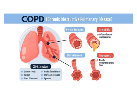 Chest specialist doctor Delhi | Chest infection