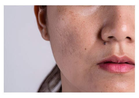 How to Identify Different Types of Pigmentation in Your Skin