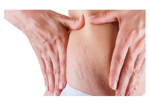 Best stretch marks treatment in Delhi