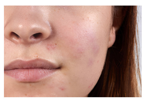 What Causes Post-Inflammatory Hyperpigmentation?