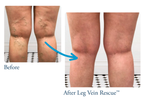 Understanding Chronic Venous Insufficiency