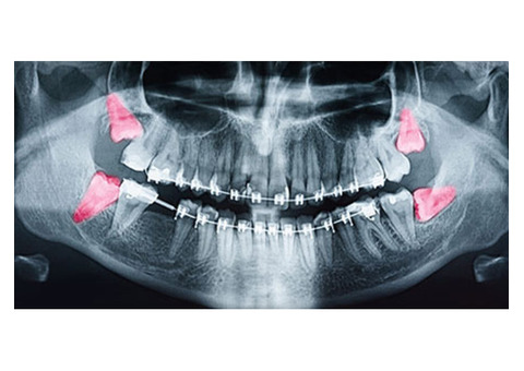 Expert Wisdom Teeth Removal Surgery New Town at Creating Smiles