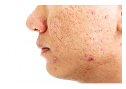 Acne Scar Treatment in Delhi Transform Your Skin