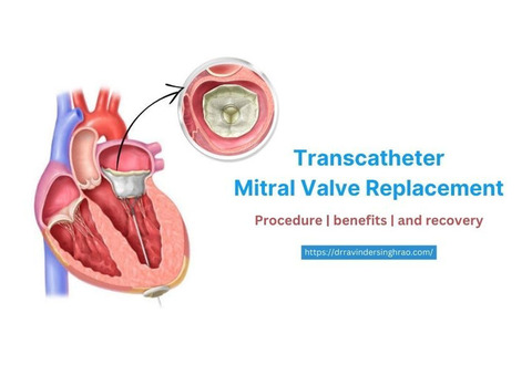 Best Doctor for Transcatheter Mitral Valve Replacement TMVR, India