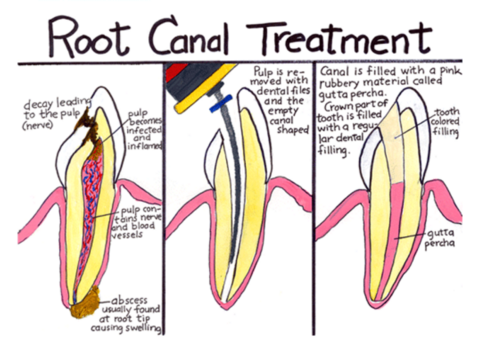 Root Canal Specialist in Lewisville,TX