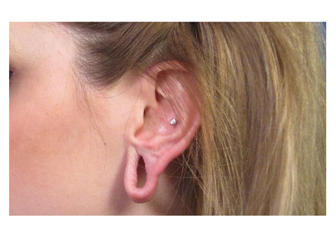 Earlobe Repair treatment in Delhi - Lobuloplasty at Skinology