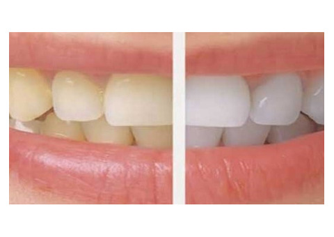 Dental Teeth Whitening And Bleaching Treatment in Coimbatore