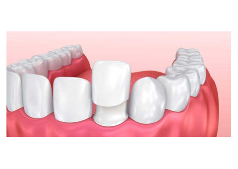 Missing Teeth Restore / Dental Implant Treatment, Coimbatore