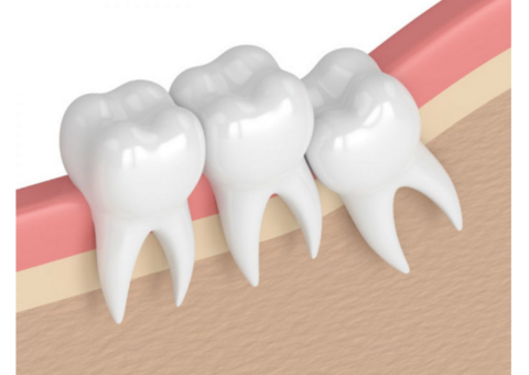 Emergency Wisdom Tooth Removal: Kirkland Premier Dentistry