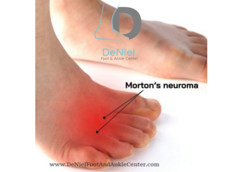 Are You Looking For The Best Mortons Neuroma in Houston?