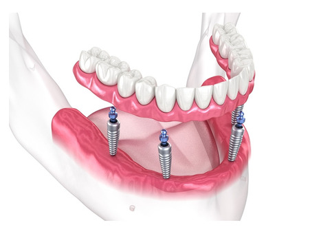 Restore Your Smile with All-on-4 Dental Implants in Miami